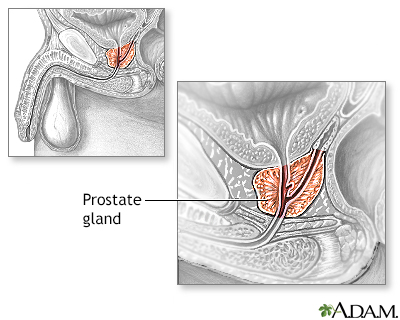 Transurethral Resection of the Prostate (TURP) - Series