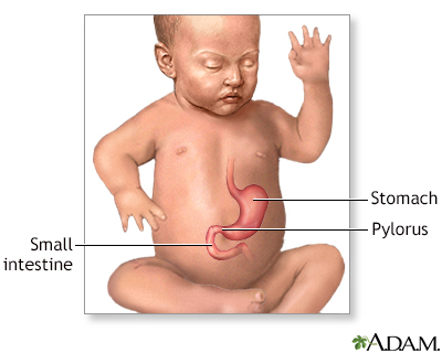 Infantile pyloric stenosis - series