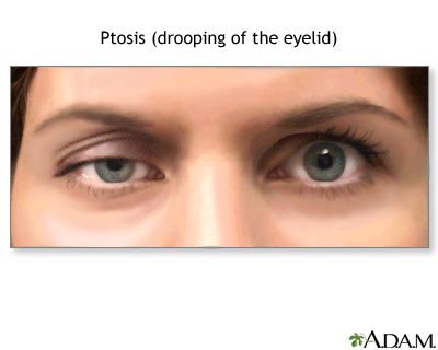 Ptosis - drooping of the eyelid