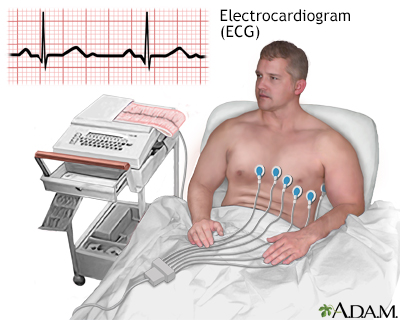 ECG