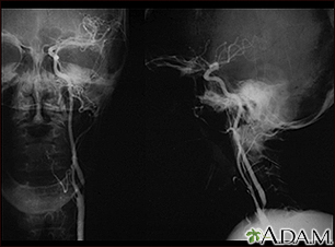 Carotid stenosis - X-ray of the left artery