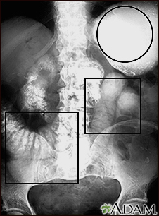 Ileus - X-ray of distended bowel and stomach