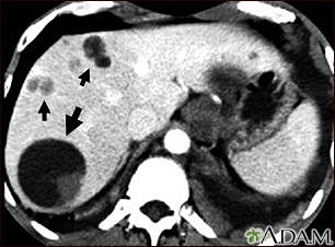 Liver echinococcus - CT scan