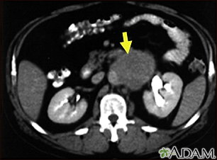 Lymph node metastases, CT scan