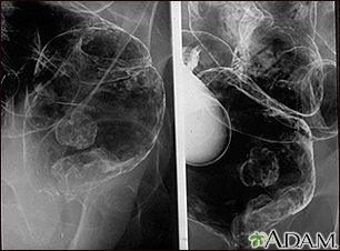 Rectal cancer - X-ray