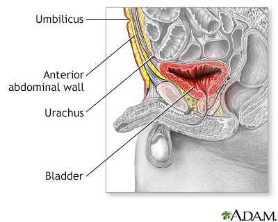 Patent urachus repair - series