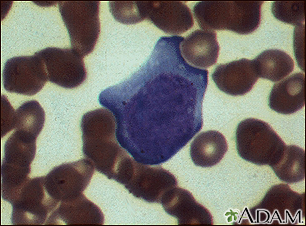 Mononucleosis - photomicrograph of cells