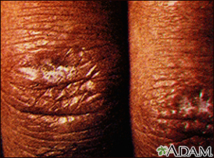 Dermatomyositis - Gottron papule