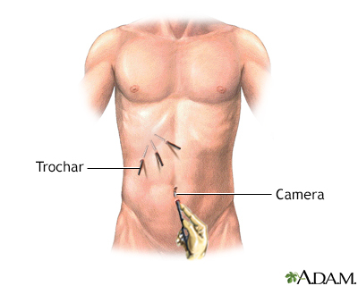 Laparoscopic surgery - series - Incision