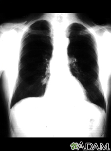 Lung nodule - front view chest X-ray