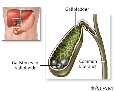 Cholelithiasis