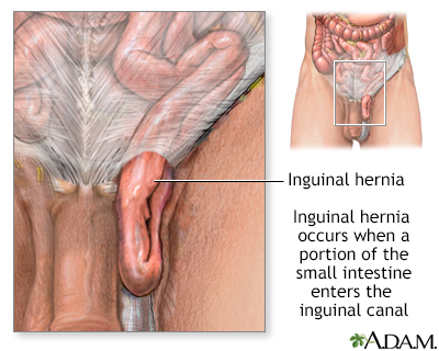 Inguinal hernia