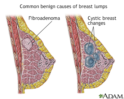 Causes of breast lumps