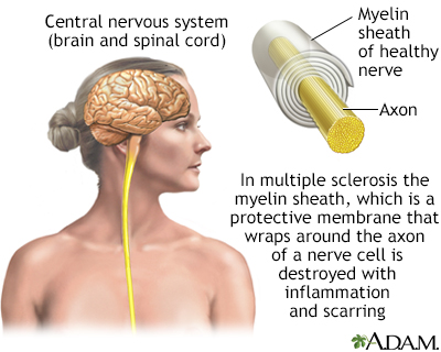 Multiple sclerosis