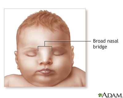 Broad nasal bridge