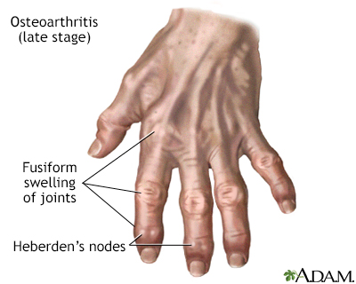 Osteoarthritis