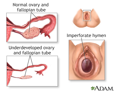 Primary amenorrhea