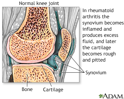 Rheumatoid arthritis