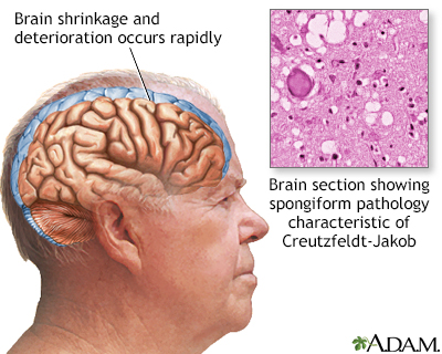 Creutzfeldt-Jakob disease