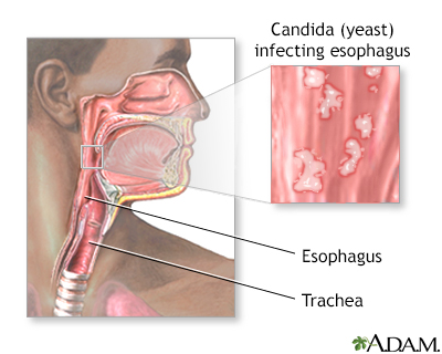 Candidal esophagitis