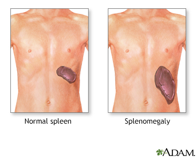 Splenomegaly