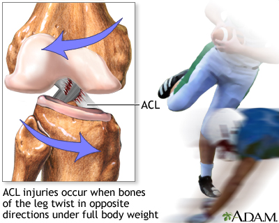 ACL injury