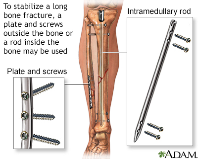 Internal fixation devices