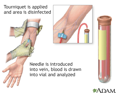 PSA blood test