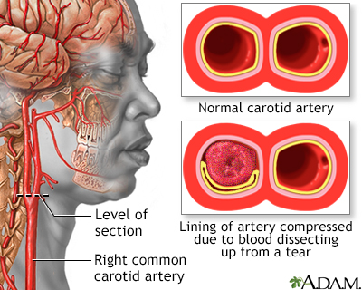 Carotid dissection