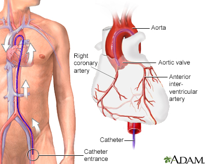 Coronary angiography