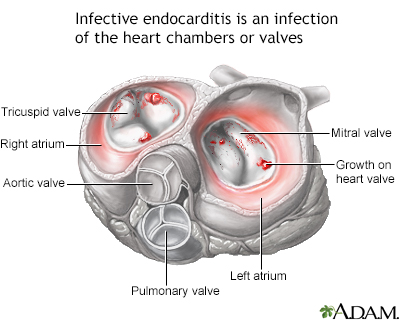 Infective endocarditis