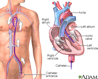 Left heart catheterization