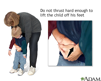 Heimlich maneuver on conscious child