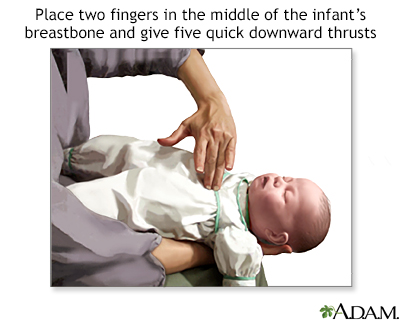 Heimlich maneuver on infant