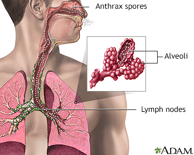 Inhalation Anthrax