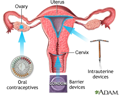 Birth control methods