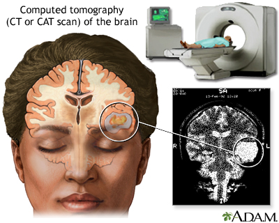 CT scan of the brain