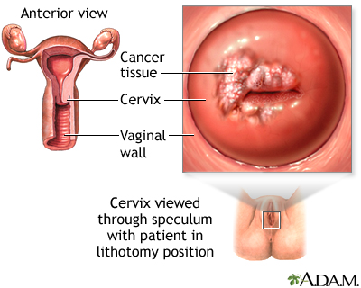 Cervical cancer