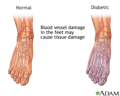 Diabetic blood circulation in foot