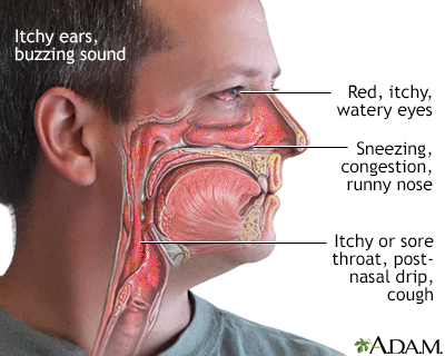 Allergy symptoms