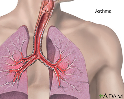 Asthma