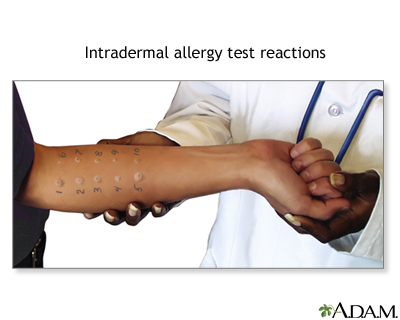 Intradermal allergy test reactions