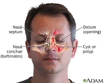 Chronic sinusitis