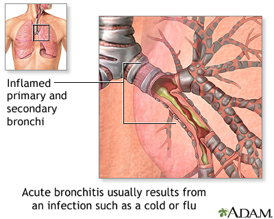 Causes of acute bronchitis