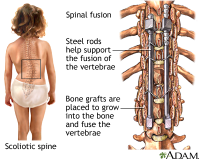 Spinal fusion