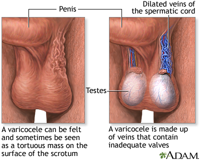 Varicocele