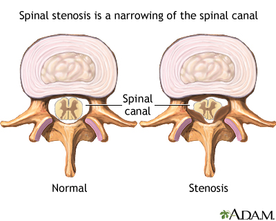 Spinal stenosis