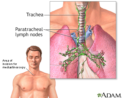 Mediastinoscopy