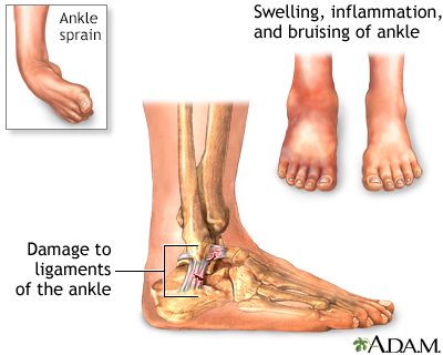 Ankle sprain