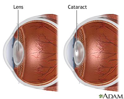 Cataract